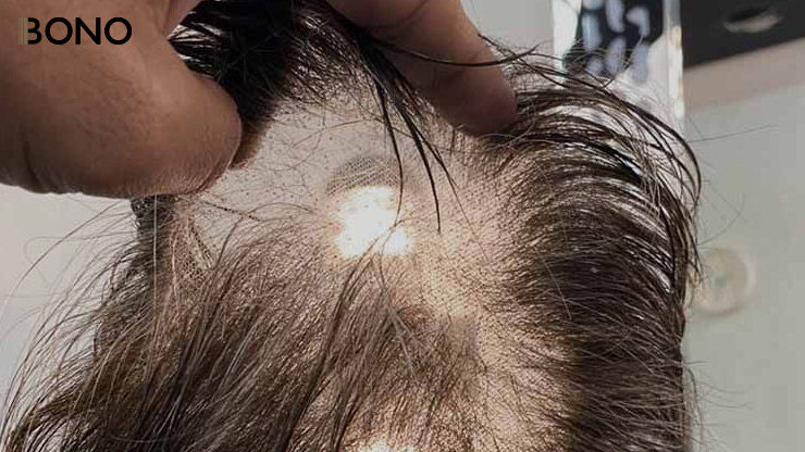 The cause of hair loss from non surgical hair replacement systems