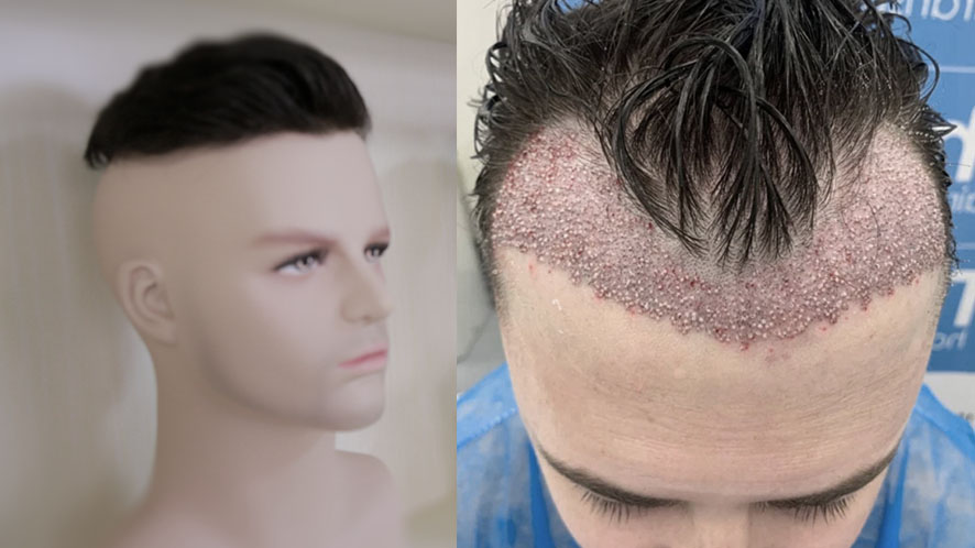 Nonsurgical Hair Replacement System vs Hair Transplant