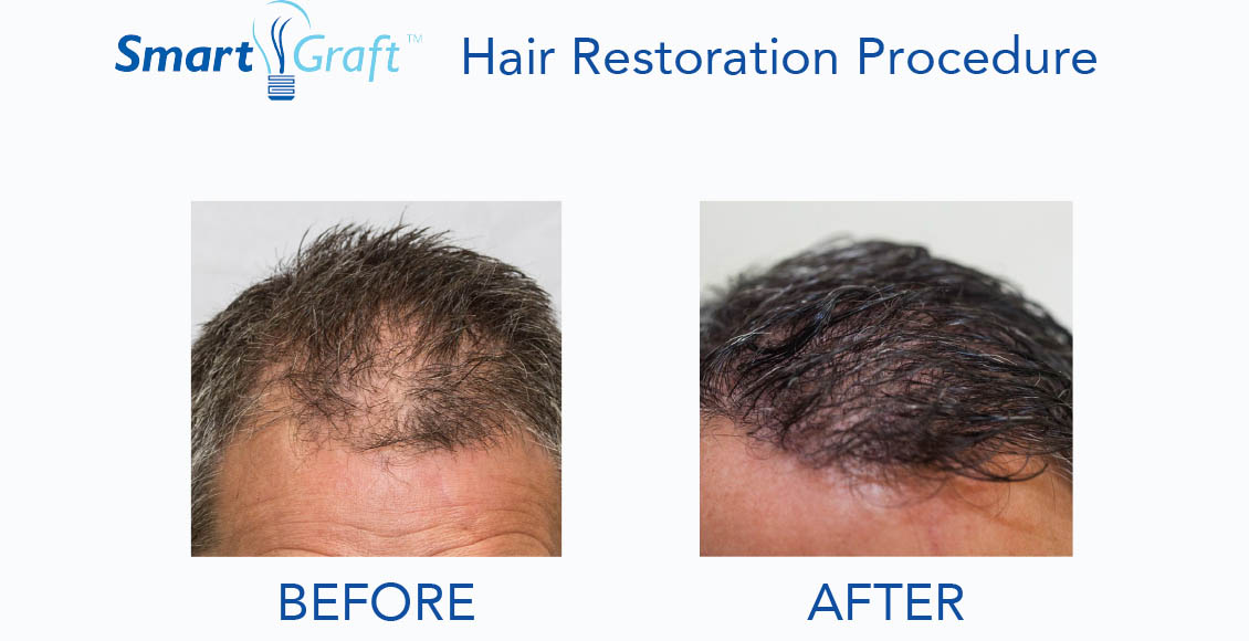 Hair replacement services (2)