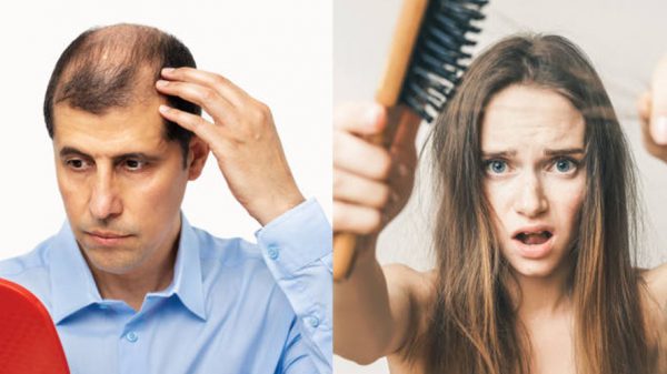 Why do men and women go bald