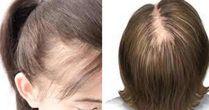 Hair Loss in Women- Causes, Types, Treatment and Solution (16)