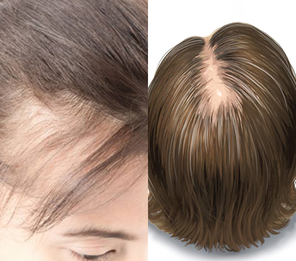 Hair Loss in Women- Causes, Types, Treatment and Solution (16)