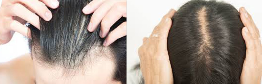Hair Loss in Women- Causes, Types, Treatment and Solution (4)