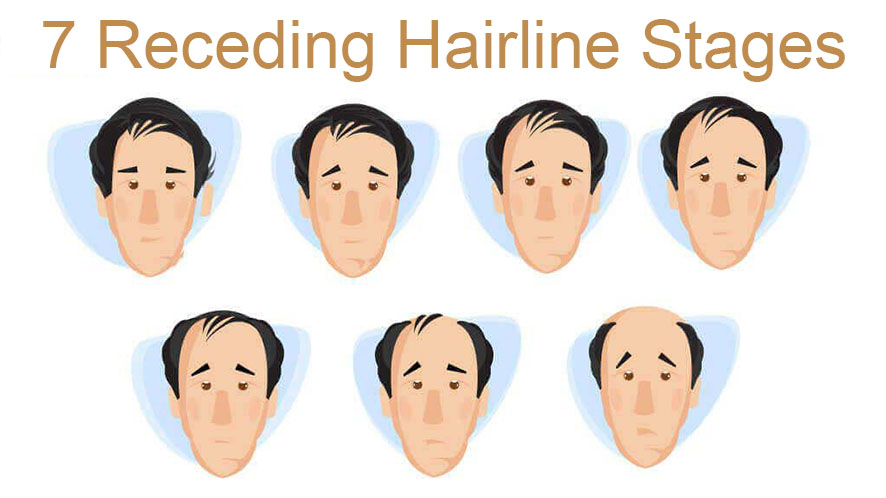 hairline receding (22)