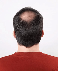 Wondering How to Solve Types of Baldness (10)