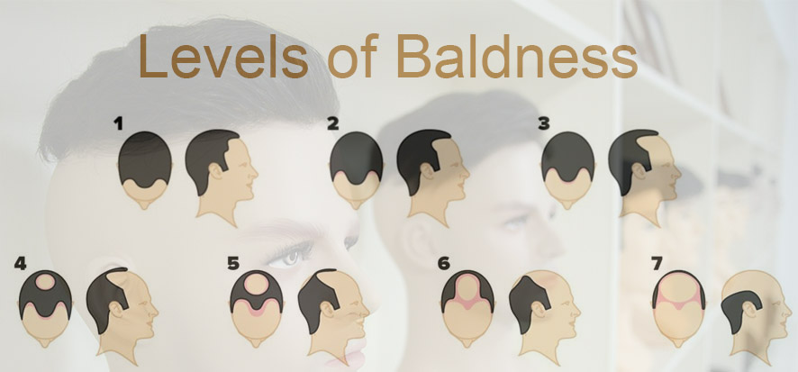 Wondering How to Solve Types of Baldness (4)