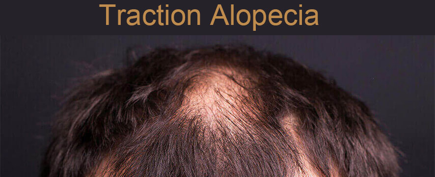 Wondering How to Solve Types of Baldness (5)