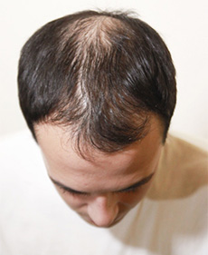 Wondering How to Solve Types of Baldness (9)