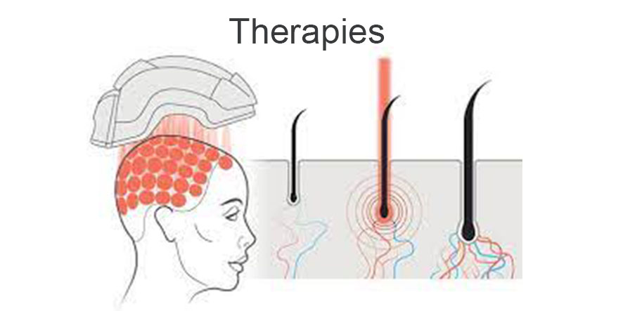 Causes of Hair Loss and Hair Loss Treatment (2)