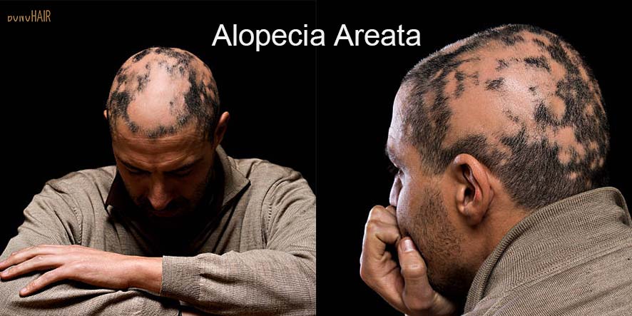 What is Alopecia and Alopecia Treatment (10)