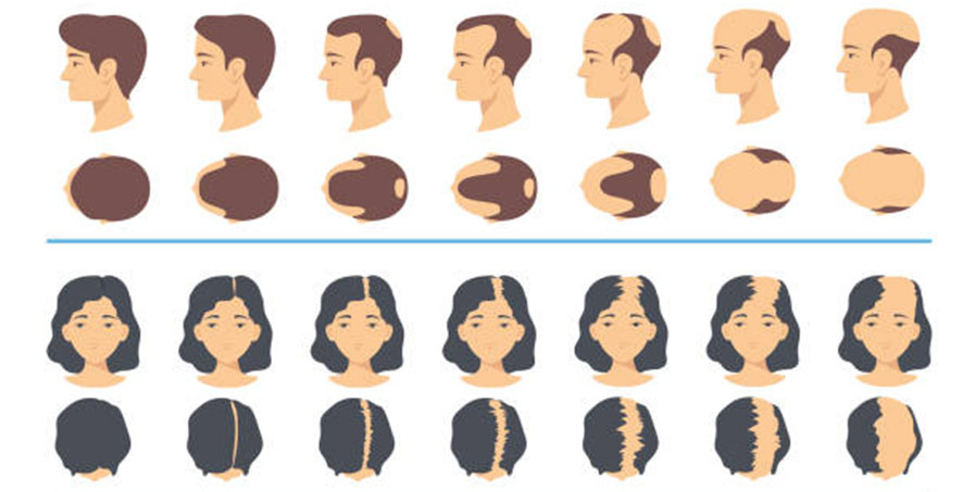 All You Need to Know about Hair Loss in Kids_Children (4)