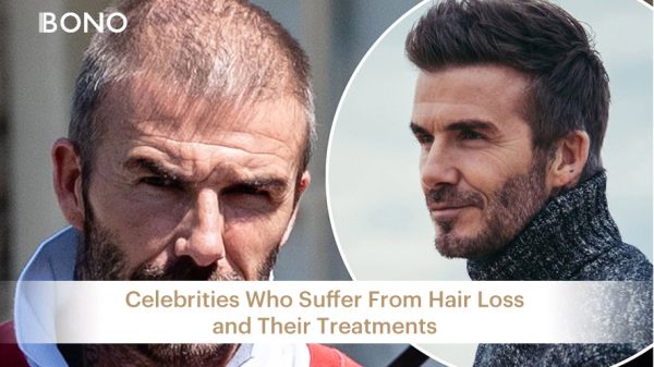 Celebrities Suffering Hair Loss (12)