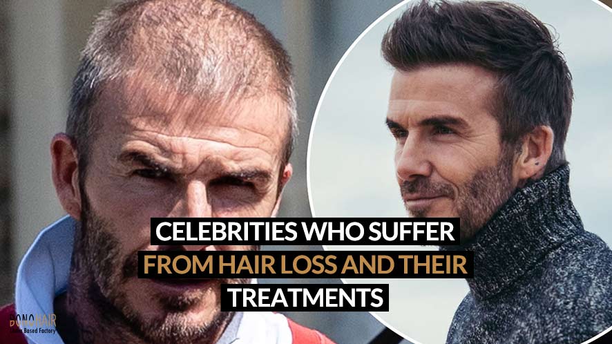 Celebrities Who Suffer from Hair Loss and Their Treatments