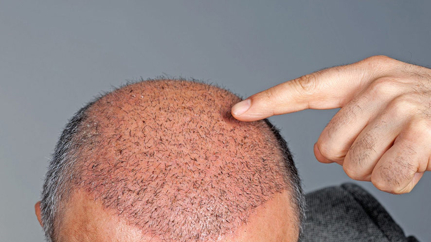 A Complete Guideline To Non-surgical Hair Restoration (1)