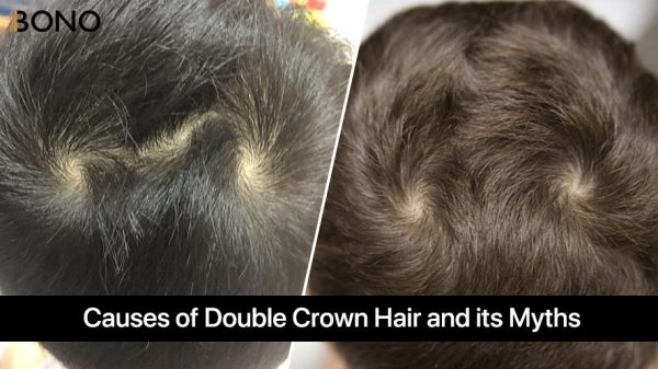 Causes of Double Crown Hair and its Myths (3)