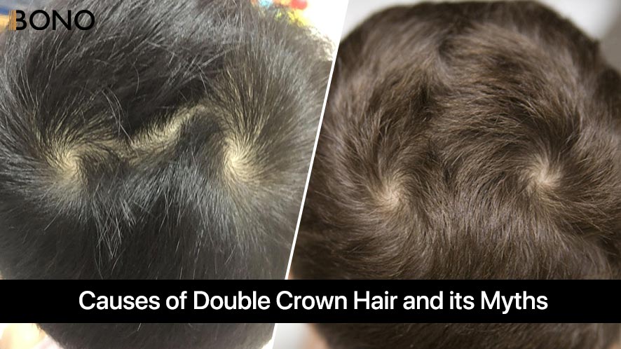 Causes of Double Crown Hair and its Myths