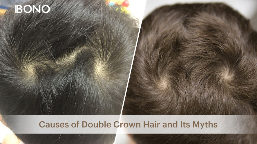 Causes Of Double Crown Hair And Its Myths Causes Of Double Crown Hair And Its Myths