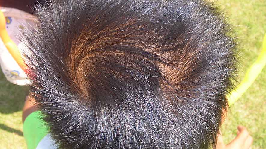 Causes of Double Crown Hair and its Myths (4)
