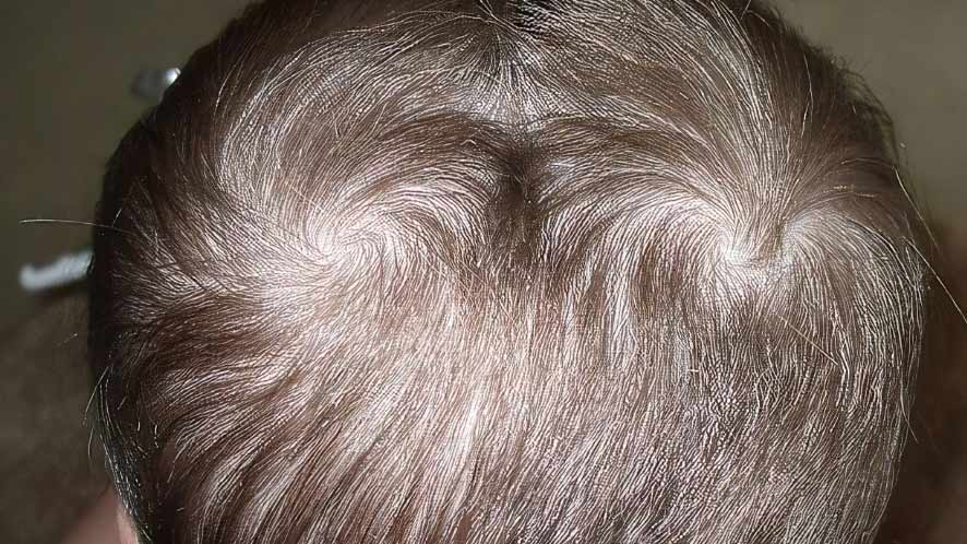 Causes of Double Crown Hair and its Myths (5)