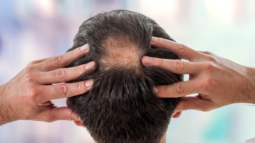 Cowlick vs. Balding Similar Yet Different Hair Problems (1)