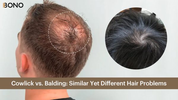 Cowlick vs. Balding Similar Yet Different Hair Problems (2)