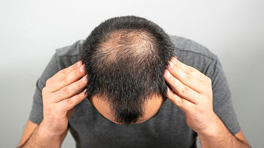 Cowlick vs. Balding Similar Yet Different Hair Problems (4)