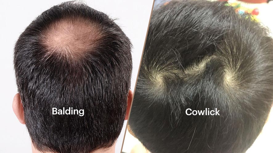 Cowlick vs. Balding Similar Yet Different Hair Problems (5)