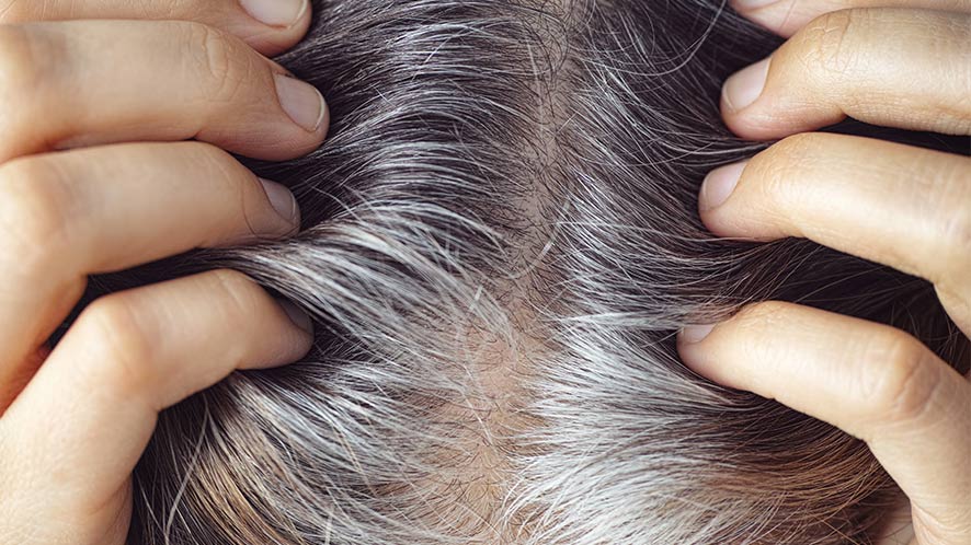 Premature Gray Hair Its Causes, Treatments, and Preventions (1)