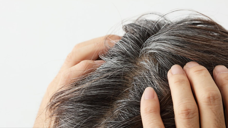 Premature Gray Hair Its Causes, Treatments, and Preventions (4)