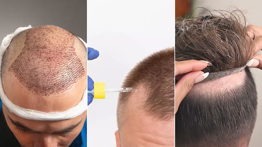 4The-Hair-System-Comeback