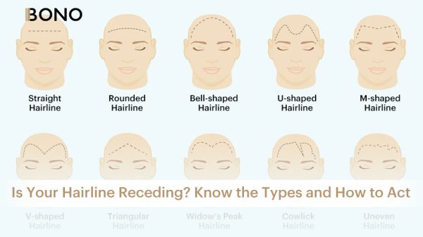 different hairline types