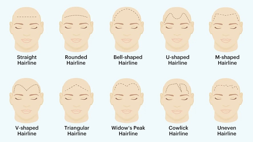 Is Your Hairline Receding Know The Types And How To Act
