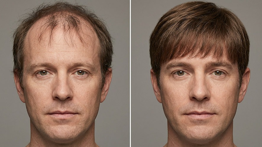 Boy bangs hairstyle before and after applying a men’s hair system for fuller look