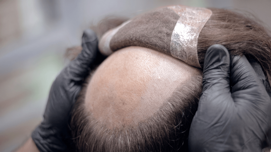 reinstall the hair system on client's head