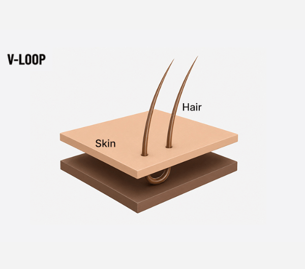 illustration of v-loop ventilation technique